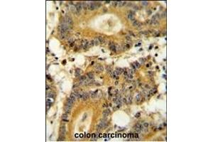 RPS6KA1 Antibody (ABIN654115 and ABIN2843994) immunohistochemistry analysis in formalin fixed and paraffin embedded human colon carcinoma followed by peroxidase conjugation of the secondary antibody and DAB staining. (RPS6KA1 Antikörper)