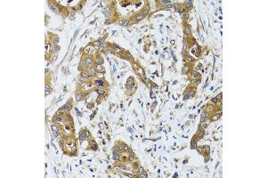 Immunohistochemistry of paraffin-embedded human colon carcinoma using BLZF1 antibody (ABIN2561429) at dilution of 1:100 (40x lens). (BLZF1 Antikörper)