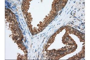Immunohistochemical staining of paraffin-embedded Adenocarcinoma of Human ovary tissue using anti-PDE4A mouse monoclonal antibody. (PDE4A Antikörper)