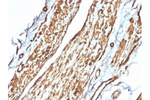 Formalin-fixed, paraffin-embedded human Testicular Carcinoma stained with VCL Mouse Monoclonal Antibody (VCL/2575). (Vinculin Antikörper  (AA 174-322))
