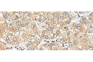 Immunohistochemistry of paraffin-embedded Human liver cancer tissue using DACT3 Polyclonal Antibody at dilution of 1:70(x200) (DACT3 Antikörper)