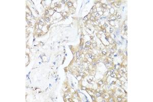 Immunohistochemistry of paraffin-embedded human liver cancer using Smad7 antibody (ABIN7270356) at dilution of 1:100 (40x lens).