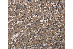 Immunohistochemistry of Human liver cancer using CAB39 Polyclonal Antibody at dilution of 1:40 (CAB39 Antikörper)