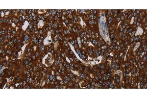 Immunohistochemistry of paraffin-embedded Human ovarian cancer tissue using KISS1R Polyclonal Antibody at dilution 1:30 (KISS1R Antikörper)
