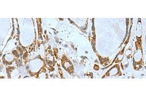 Immunohistochemistry of paraffin-embedded Human thyroid cancer tissue using TSGA10 Polyclonal Antibody at dilution of 1:50(x200) (TSGA10 Antikörper)