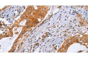 Immunohistochemistry of paraffin-embedded Human cervical cancer using CDK19 Polyclonal Antibody at dilution of 1:70 (CDK19 Antikörper)