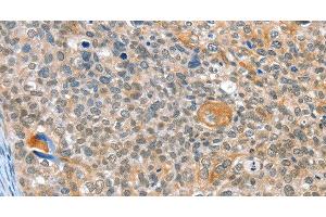 Immunohistochemistry of paraffin-embedded Human cervical cancer using ALDOB Polyclonal Antibody at dilution of 1:40 (ALDOB Antikörper)