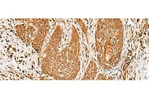 Immunohistochemistry of paraffin-embedded Human esophagus cancer tissue using PPOX Polyclonal Antibody at dilution of 1:30(x200) (PPOX Antikörper)