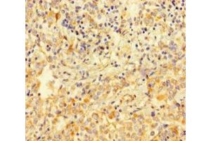 Immunohistochemistry of paraffin-embedded human lung cancer using ABIN7175511 at dilution of 1:100