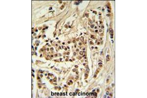 TTPAL Antibody IHC analysis in formalin fixed and paraffin embedded human breast carcinoma followed by peroxidase conjugation of the secondary antibody and DAB staining. (TTPAL Antikörper  (C-Term))