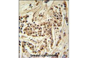 TTPAL Antibody IHC analysis in formalin fixed and paraffin embedded human breast carcinoma followed by peroxidase conjugation of the secondary antibody and DAB staining.