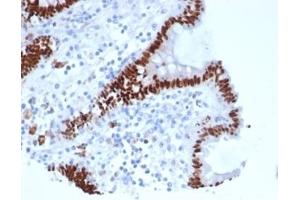Formalin-fixed, paraffin-embedded human colon carcinoma stained with CDX2 Recombinant Mouse Monoclonal Antibody (rCDX2/6921). (Rekombinanter CDX2 Antikörper)