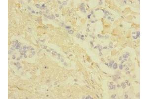 Immunohistochemistry of paraffin-embedded human pancreatic cancer using ABIN7147896 at dilution of 1:100 (Claudin 18 Antikörper  (AA 20-80))