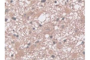DAB staining on IHC-P; Samples: Human Glioma Tissue (Interferon gamma Antikörper  (AA 24-166))