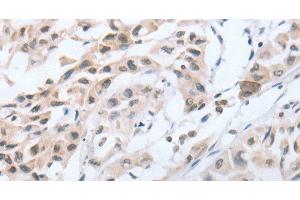 Immunohistochemistry of paraffin-embedded Human lung cancer tissue using CHRNA10 Polyclonal Antibody at dilution 1:50 (CHRNA10 Antikörper)
