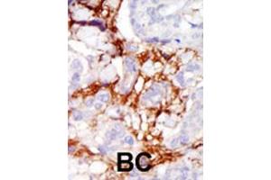 Formalin-fixed and paraffin-embedded human cancer tissue reacted with the primary antibody, which was peroxidase-conjugated to the secondary antibody, followed by AEC staining. (PAK3 Antikörper  (AA 218-247))