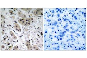 Immunohistochemical analysis of paraffin- embedded breast carcinoma, using Akt (Phospho-Ser473) Antibody. (AKT1 Antikörper  (pSer473))