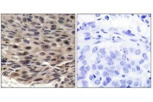 Immunohistochemical analysis of paraffin-embedded human breast carcinoma, using 4E-BP1 (phospho-Thr36) antibody. (eIF4EBP1 Antikörper  (pThr36))