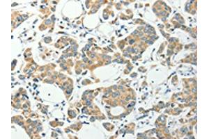 The image on the left is immunohistochemistry of paraffin-embedded Human colon cancer tissue using ABIN7191847(PFDN6 Antibody) at dilution 1/35, on the right is treated with synthetic peptide. (PFDN6 Antikörper)
