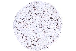 High Ki67 LI in a breast cancer NST (Ki-67 Antikörper  (AA 2293-2478))