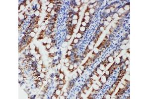 IHC-P: FER antibody testing of human intestinal cancer tissue (FER Antikörper  (Middle Region))