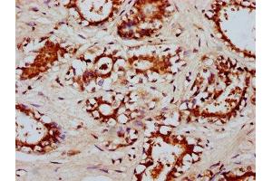 IHC image of ABIN7174060 diluted at 1:200 and staining in paraffin-embedded human breast cancer performed on a Leica BondTM system. (RYK Antikörper  (AA 494-586))