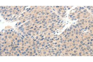 Immunohistochemistry of paraffin-embedded Human breast cancer tissue using SCN10A Polyclonal Antibody at dilution 1:25 (Nav1.8 Antikörper)