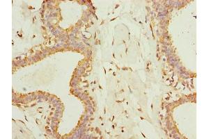Immunohistochemistry of paraffin-embedded human breast cancer using ABIN7173083 at dilution of 1:100 (TMEM161A Antikörper  (AA 29-98))