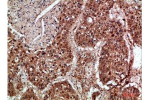 Immunohistochemical analysis of paraffin-embedded human-lung-cancer, antibody was diluted at 1:200 (TICAM1 Antikörper  (AA 663-712))