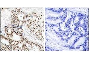Immunohistochemistry analysis of paraffin-embedded human breast carcinoma, using BRCA1 (Phospho-Ser1423) Antibody. (BRCA1 Antikörper  (pSer1423))