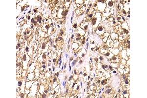 Immunohistochemistry of paraffin-embedded Human kidney cancer using TCEB3 Polyclonal Antibody at dilution of 1:100 (40x lens). (TCEB3 Antikörper)