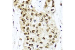 Immunohistochemistry of paraffin-embedded human lung cancer using TET2 antibody. (TET2 Antikörper)