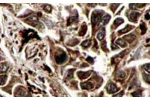 Immunohistochemistry of RFFL polyclonal antibody  shows strong cytoplasmic and membranous staining of tumor cells in cancerous human liver tissue. (RFFL Antikörper  (AA 1-363))