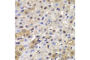 Immunohistochemistry of paraffin-embedded human liver cancer using MAD1L1 antibody. (MAD1L1 Antikörper  (AA 360-700))