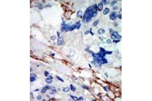 Formalin-fixed and paraffin-embedded human cancer tissue reacted with the primary antibody, which was peroxidase-conjugated to the secondary antibody, followed by DAB staining. (DYRK2 Antikörper  (N-Term))