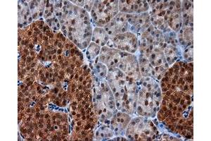 Immunohistochemical staining of paraffin-embedded Adenocarcinoma of colon tissue using anti-SRR mouse monoclonal antibody. (SRR Antikörper)