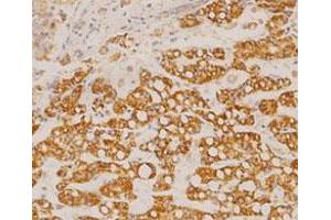 Immunohistochemical staining of human liver cancer tissue section with GOT2 monoclonal antibody, clone 14  at 1:100 dilution. (GOT2 Antikörper  (AA 225-430))