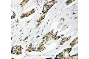 Anti-Hsp105 antibody, IHC(P) IHC(P): Human Mammary Cancer Tissue (HSPH1 Antikörper  (C-Term))