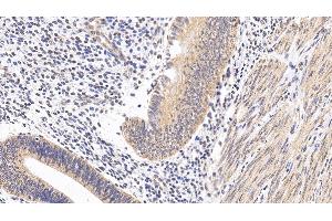 Detection of MAPK14 in Human Endometrial cancer Tissue using Polyclonal Antibody to Mitogen Activated Protein Kinase 14 (MAPK14) (MAPK14 Antikörper  (AA 19-279))