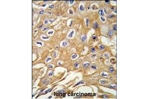 Formalin-fixed and paraffin-embedded human lung carcinoma tissue reacted with RIP3 (RIPK3) antibody (Center) (ABIN391273 and ABIN2841323) , which was peroxidase-conjugated to the secondary antibody, followed by DAB staining. (RIPK3 Antikörper  (AA 61-91))