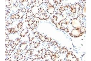 Formalin-fixed, paraffin-embedded human thyroid stained with TTF1 antibody (NX2. (TTF1 Antikörper)