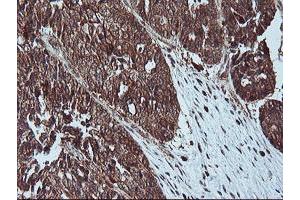 Immunohistochemical staining of paraffin-embedded Adenocarcinoma of Human ovary tissue using anti-LIMK1 mouse monoclonal antibody. (LIM Domain Kinase 1 Antikörper)
