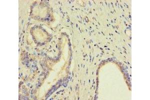 Immunohistochemistry of paraffin-embedded human prostate cancer using ABIN7173007 at dilution of 1:100 (TMPRSS11D Antikörper  (AA 201-418))