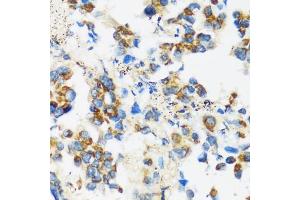 Immunohistochemistry of paraffin-embedded human lung cancer using F antibody (ABIN3016158, ABIN3016159, ABIN3016160 and ABIN6219586) at dilution of 1:100 (40x lens). (APOBEC3F Antikörper  (AA 1-65))