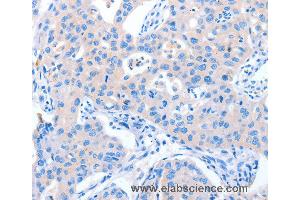 Immunohistochemistry of Human lung cancer using NUAK1 Polyclonal Antibody at dilution of 1:60 (NUAK1 Antikörper)