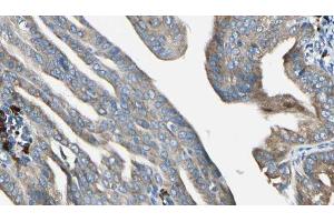 ABIN6272952 at 1/100 staining Human cervical cancer tissue by IHC-P. (SLC30A7 Antikörper  (N-Term))