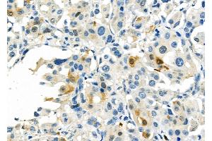 ABIN6260628 and ABIN6276794 at 1/100 staining Human lung cancer by IHC-P. (CD46 Antikörper  (N-Term))