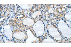 Immunohistochemistry of paraffin-embedded Human thyroid cancer tissue using HID1 Polyclonal Antibody at dilution 1:50 (HID1/DMC1 Antikörper)