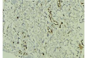 ABIN6272454 at 1/100 staining Human breast cancer tissue by IHC-P.