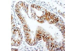 IHC-P: CCR5 antibody testing of human rectal cancer tissue (CCR5 Antikörper  (N-Term))